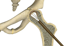 Core Decompression for Avascular Necrosis of the Hip