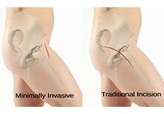 Minimally Invasive Hip Replacement