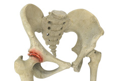 Hip Arthritis