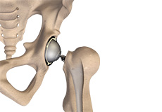 Total Hip Replacement